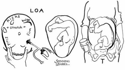 Optimal Fetal Positioning - LOA